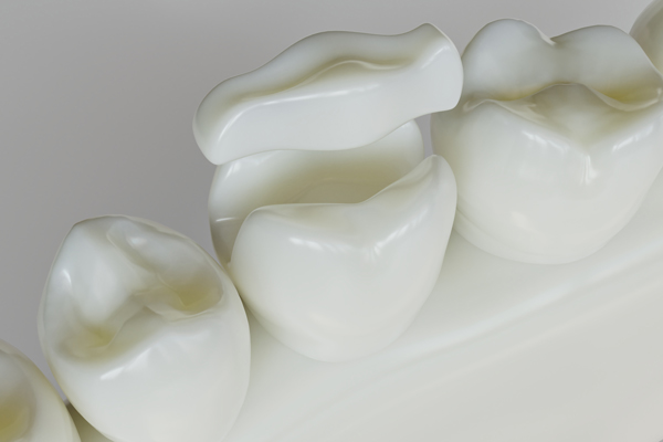 Ansicht eines Zahnmodells mit Inlays